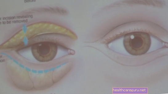 كيفية علاج الانتفاخات تحت العينين