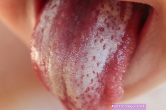 كيفية استخدام "نيستاتين جل" لعلاج مرض القلاع في الفم