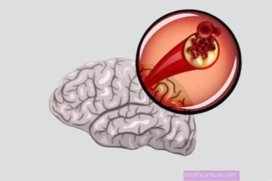 نقص التروية الدماغي: ما هو ، الأعراض والعلاج