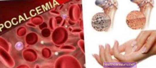 نقص كالسيوم الدم: الأعراض والأسباب والعلاج