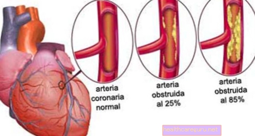 نقص تروية القلب: ما هو وأهم الأعراض والعلاج