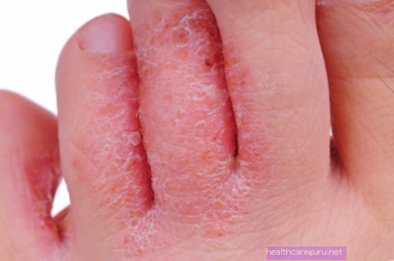 7 أنواع من سعفة الجلد وكيفية علاجها