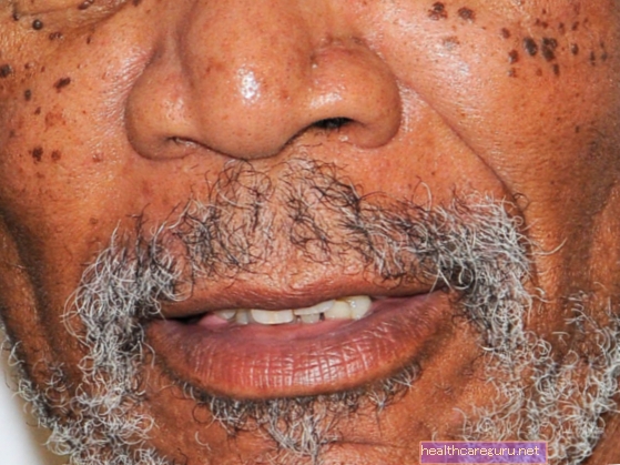 التهاب الجلد الحطاطي الأسود: ما هو ، الأسباب ، الأعراض والعلاج