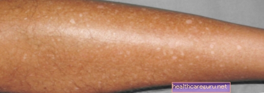Leucoderma gutata (النمش الأبيض): ما هو وكيفية علاجه