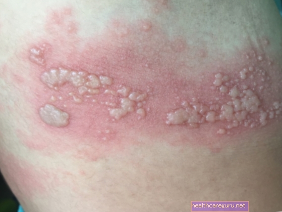 ما هو التهاب الجلد الدرهمي وأهم أعراضه