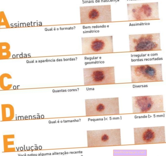 علامات وأعراض سرطان الجلد على الجلد (طريقة ABCD)