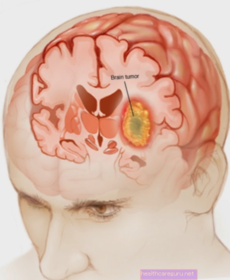 أنواع أورام المخ وعلاجها وعواقبها المحتملة