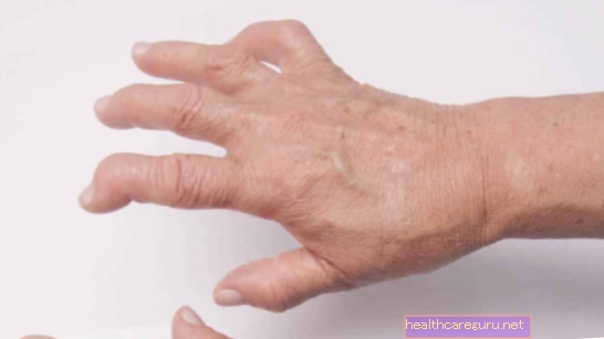التهاب المفاصل في اليدين: الأعراض والأسباب والعلاج