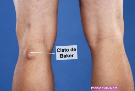 قد يكون الورم خلف الركبة عبارة عن كيس بيكر