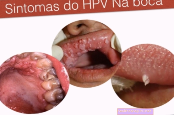 فيروس الورم الحليمي البشري في الفم: الأعراض والعلاج وطرق انتقاله
