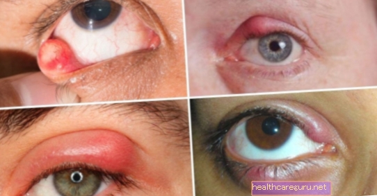 البردة في العين: ما هي أهم الأعراض وعلاجها