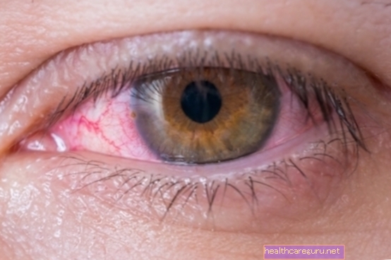 كيفية علاج التهاب الملتحمة: مراهم وقطرات للعين والعناية اللازمة