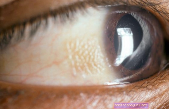بقعة بيضاء على العين: ما يمكن أن تكون ومتى تذهب إلى الطبيب
