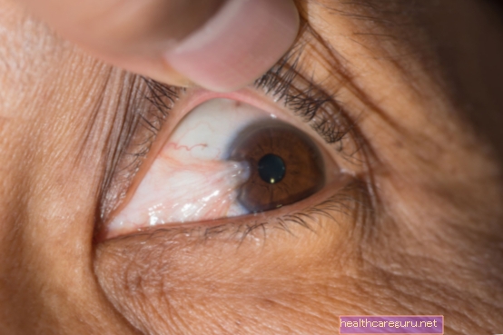 الظفرة في العين: ما هي الأعراض الرئيسية والعلاج