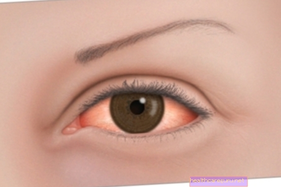 وردية العين: ما هي ، الأعراض والعلاج