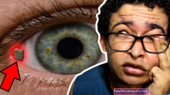 كيفية إزالة البقعة من العين