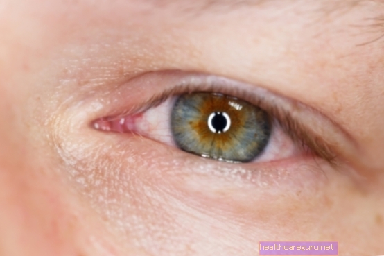 6 أسباب رئيسية لحكة العيون وماذا تفعل