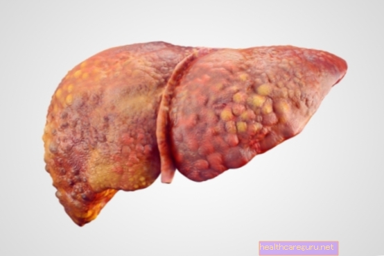 8 أعراض رئيسية لدهون الكبد