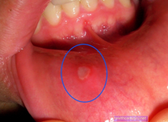 ألم في سقف الفم: 5 أسباب رئيسية وماذا تفعل