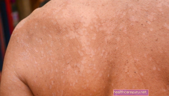 أعراض سعفة الجلد والقدم والأظافر